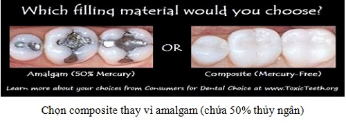 Amalgam – loại vật liệu hàn răng chứa Thủy ngân cần được loại bỏ