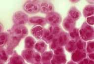 Ca bệnh lậu ‘tồi tệ nhất thế giới’ đã được chữa khỏi