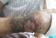 Tự tháo bó bột để đắp lá chữa gãy xương, người phụ nữ suýt mất tay