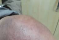 Bị cứng khớp do đắp lá suốt 3 tháng