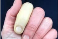 Căn bệnh bí hiểm nào khiến ngón tay đổi màu trắng bệch