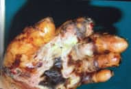 Người đàn ông bị hoại tử cả bàn tay do máy ép mía nghiến