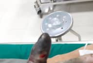 Hoại tử ngón tay do đắp thuốc nam vào vết rắn hổ mang cắn