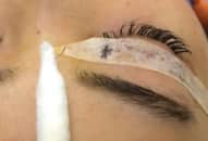 Bác sĩ mò tìm chiếc kim trong mắt cô gái trẻ Hà Nội