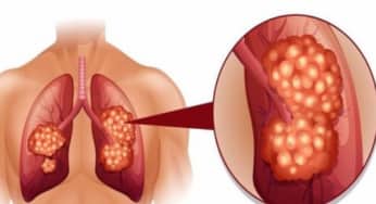 13 dấu hiệu cơ thể cảnh báo đang trong giai đoạn đầu của ung thư trước 2-5 năm