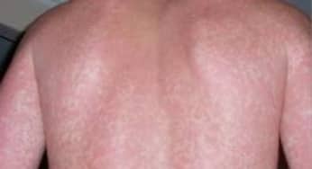 Khi bị sốt xuất huyết mà làm việc này để bệnh nhân sớm khỏe cực kỳ nguy hiểm phải tránh xa