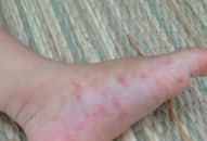 Sốt xuất huyết có nguy cơ bùng phát ở phía Bắc