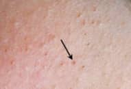 Nguyên nhân và biến chứng nguy hiểm của bệnh viêm lỗ chân lông