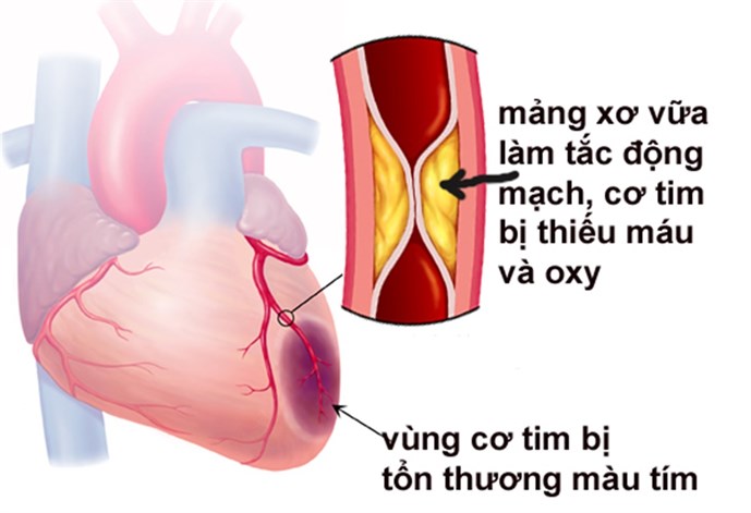 Chuyên gia tim mạch giúp phân biệt nhồi máu cơ tim và tai biến mạch máu não