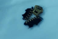 Chàng trai nhập viện với ‘cậu nhỏ’ bị kẹt trong dây kéo khóa quần