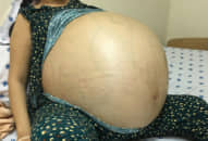 Bác sĩ hút 48 lít dịch khỏi buồng trứng người phụ nữ