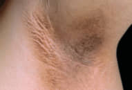 Acanthosis Nigricans là bệnh gì?