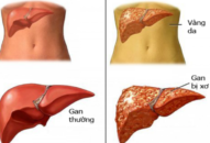 Bảo vệ, phục hồi tế bào gan sớm – Mấu chốt duy trì sức khỏe đường dài cho gan