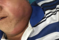 Ổ áp xe họng làm biến dạng mặt người đàn ông