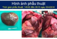 Hiếm gặp: Cắt u gan “khủng” 5kg ở bệnh nhân u cơ mỡ mạch gan