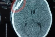 Bị thanh niên đập chai bia vào đầu, bé trai chấn thương sọ não