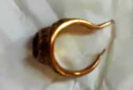 Bác sĩ dùng kìm cắt chiếc nhẫn vàng khỏi ‘cậu nhỏ’ bệnh nhân