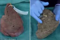 Khác biệt giữa gan của người khỏe mạnh và người nghiện rượu