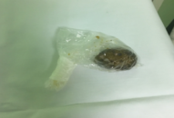 Chàng trai bị tắc ruột sau khi ăn nấm đông cô