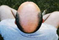 Hy vọng mới về thuốc chữa hói đầu