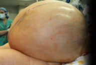 Khối u 60 kg khiến bụng người phụ nữ tròn căng như trống