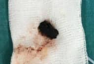 Cụ bà 77 tuổi bị suy hô hấp cấp do hóc hạt ô mai