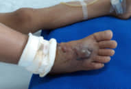 Bé 7 tuổi nguy cơ hoại tử chân do bị rắn lục cắn