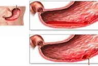 Thiết bị nội soi kiểm soát chảy máu đường tiêu hóa