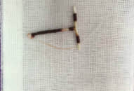 Vòng tránh thai đi lạc trong ổ bụng người phụ nữ