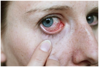 Đi tìm lời giải về nguyên nhân khiến 48 người mắc bệnh ung thư mắt hiếm gặp