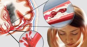 Bệnh đột quỵ: Y học chuyên sâu về cách sơ cứu và phòng bệnh