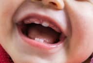 Dấu hiệu trẻ mọc răng và giảm đau răng cho trẻ