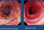 Bệnh Crohn: triệu chứng lâm sàng, hình ảnh nội soi