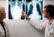 Phác đồ điều trị bệnh lao phổi mới nhất của Bộ Y tế