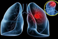 Ung thư phế quản phổi: Chẩn đoán xác định, triệu chứng, giai đoạn bệnh