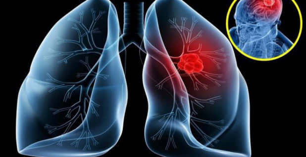 Ung thư phế quản phổi: Chẩn đoán xác định, triệu chứng, giai đoạn bệnh
