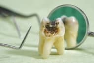 Biến chứng nguy hiểm của bệnh viêm tủy răng