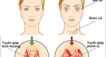 Các loại thực phẩm mà người bị bướu cổ không nên bỏ qua