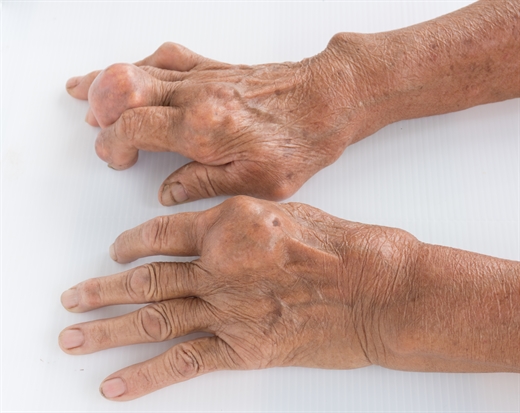 Bí kíp giảm đau hiệu quả cho bệnh nhân gout không phải ai cũng biết