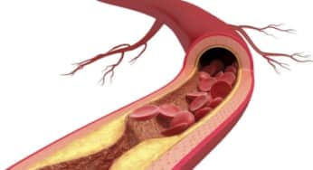 Các yếu tố nguy cơ gây xơ vữa động mạch