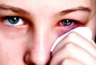 Kiêng khem khi bị đau mắt đỏ, viêm kết mạc