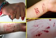 Hội chứng tự hại, self harm, self injury/cutting
