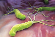 Nhiễm vi khuẩn Helicobacter Pylori – HP có trở thành ung thư?