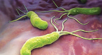 Nhiễm vi khuẩn Helicobacter Pylori – HP có trở thành ung thư?