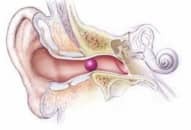 Nội soi lấy dị vật ở tai có gây tê tại chỗ