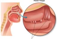 Polyp mũi: Các bước phẫu thuật, tai biến và xử trí