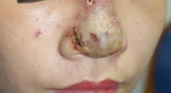 Tiêm chất làm đầy, filler, biến làm đẹp thành thảm họa chết người