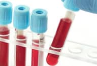 Truyền máu: Điều gì sẽ xảy ra nếu bạn nhận nhầm nhóm máu? Lượng máu, thành phần