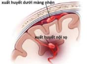Xuất huyết não (xuất huyết nội sọ): nguyên nhân, triệu chứng và diễn biến bệnh
