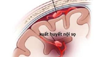 Xuất huyết não (xuất huyết nội sọ): nguyên nhân, triệu chứng và diễn biến bệnh
